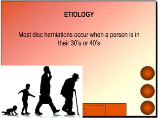 ETIOLOGY
Most disc herniations occur when a person is in
their 30’s or 40’s
 
