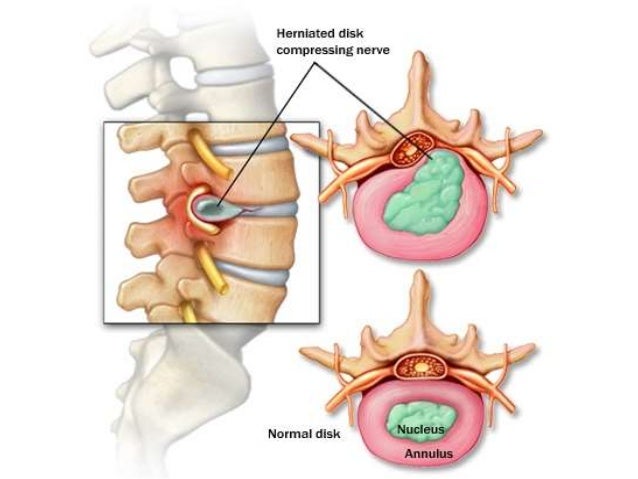 Herniated Nucleus Pulposus