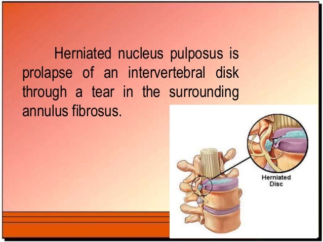 Herniated Nucleus Pulposus slideshare - 웹