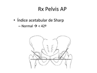 Rx Pelvis AP
• Índice acetabular de Sharp
– Normal  < 42º
 