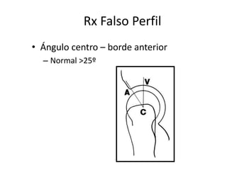 Rx Falso Perfil
• Ángulo centro – borde anterior
– Normal >25º
 