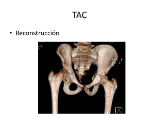 TAC
• Reconstrucción
 