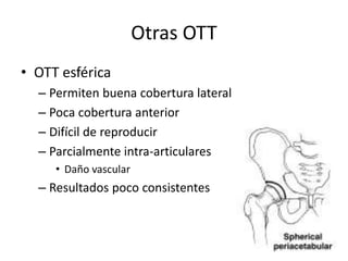 Otras OTT
• OTT esférica
– Permiten buena cobertura lateral
– Poca cobertura anterior
– Difícil de reproducir
– Parcialmente intra-articulares
• Daño vascular
– Resultados poco consistentes
 