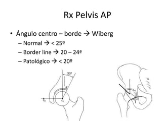 Rx Pelvis AP
• Ángulo centro – borde  Wiberg
– Normal  < 25º
– Border line  20 – 24ª
– Patológico  < 20º
 