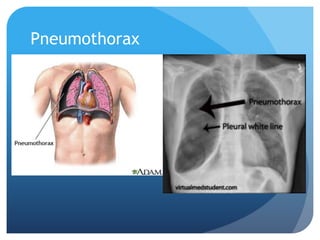 Pneumothorax
 