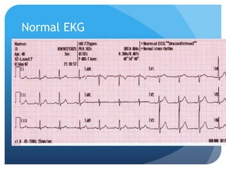 Normal EKG
 