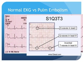 Normal EKG vs Pulm Embolism
 
