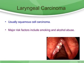 Laryngeal Carcinoma
• Usually squamous cell carcinoma.
• Major risk factors include smoking and alcohol abuse.
 