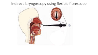 Indirect laryngoscopy using flexible fibrescope.
 