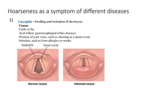 Hoarseness as a symptom of different diseases
1)
 