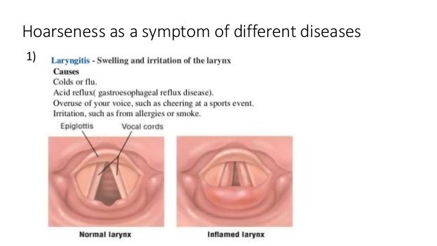 Hoarseness hoarseness