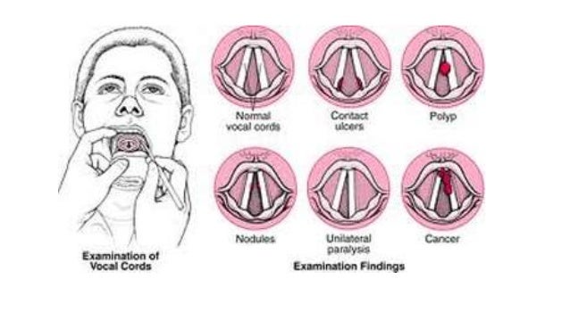 Hoarseness Hoarseness