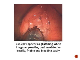 Clinically appear as glistening white
irregular growths, pedunculated or
sessile, friable and bleeding easily
 