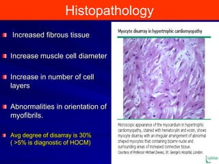 Histopathology
Increased fibrous tissue

Increase muscle cell diameter
Increase in number of cell
layers
Abnormalities in orientation of
myofibrils.
Avg degree of disarray is 30%
( >5% is diagnostic of HOCM)

 