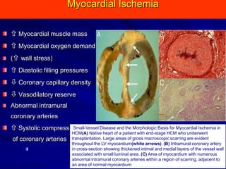 Myocardial Ischemia
 Myocardial muscle mass
 Myocardial oxygen demand
( wall stress)

 Diastolic filling pressures
 Coronary capillary density

 Vasodilatory reserve
Abnormal intramural
coronary arteries
Small-Vessel Disease and the Morphologic Basis for Myocardial Ischemia in
 Systolic compression

of coronary arteries

HCM(A) Native heart of a patient with end-stage HCM who underwent
transplantation. Large areas of gross macroscopic scarring are evident
throughout the LV myocardium(white arrows). (B) Intramural coronary artery
in cross-section showing thickened intimal and medial layers of the vessel wall
associated with small luminal area. (C) Area of myocardium with numerous
abnormal intramural coronary arteries within a region of scarring, adjacent to
an area of normal myocardium.

 