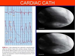 CARDIAC CATH

 