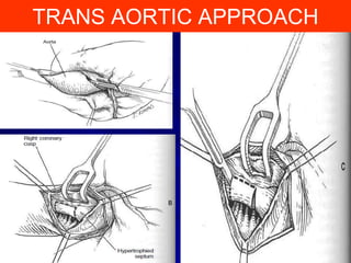 TRANS AORTIC APPROACH

 
