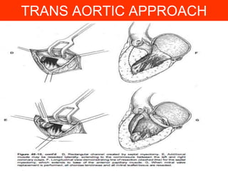 TRANS AORTIC APPROACH

 