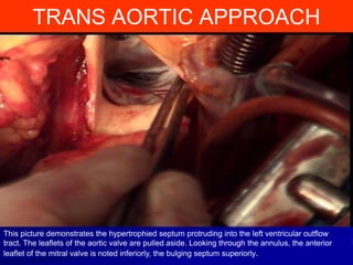 TRANS AORTIC APPROACH

This picture demonstrates the hypertrophied septum protruding into the left ventricular outflow
tract. The leaflets of the aortic valve are pulled aside. Looking through the annulus, the anterior
leaflet of the mitral valve is noted inferiorly, the bulging septum superiorly.

 
