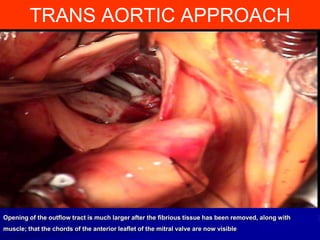 TRANS AORTIC APPROACH

Opening of the outflow tract is much larger after the fibrious tissue has been removed, along with
muscle; that the chords of the anterior leaflet of the mitral valve are now visible

 