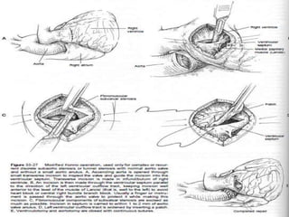 Modified konno operation

 