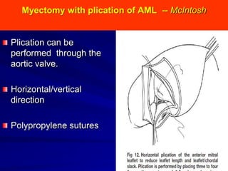 Myectomy with plication of AML -- McIntosh

Plication can be
performed through the
aortic valve.
Horizontal/vertical
direction
Polypropylene sutures

 