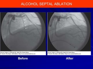 ALCOHOL SEPTAL Ablation
Alcohol Septal ABLATION

Before

After

 