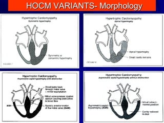 HOCM VARIANTS- Morphology

2

 