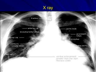 X ray

Cardiomegaly
LA enlargement

Small aorta
Pulmonary edema

 