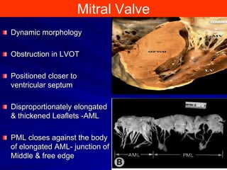 Mitral Valve
Dynamic morphology
Obstruction in LVOT
Positioned closer to
ventricular septum
Disproportionately elongated
& thickened Leaflets -AML

PML closes against the body
of elongated AML- junction of
Middle & free edge

 