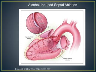 Braunwald, E. N Engl J Med 2002;347:1306-1307
Alcohol-Induced Septal Ablation
 