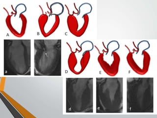 Management of HOCM | PPTX