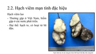 2.2. Hạch viêm mạn tính đặc hiệu
Hạch viêm lao
- Thường gặp ở Việt Nam, hiếm
gặp ở các nước phát triển.
- Đại thể: hạch to, có hoại tử bã
đậu.
 
