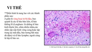 VI THỂ
**Điển hình là nang lao với các thành
phần sau:
ở giữa là vùng hoại tử bã đậu, bao
quanh là các tế bào bán liên, tế bào
khổng lồ (Langhans: là những tế bào
kích thước lớn ,chứa nhiều nhân,các
nhân sắp xếp hình vòng cung,hoặc tập
trung lại một đầu, bào tương bắt màu
đỏ đậm) và tế bào lympho, ngoài cùng
là lớp tế bào xơ.
 