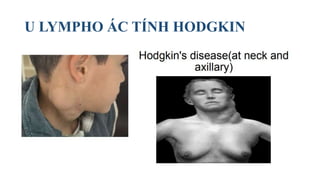 U LYMPHO ÁC TÍNH HODGKIN
 