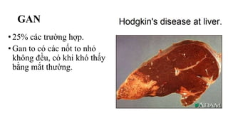 GAN
•25% các trường hợp.
•Gan to có các nốt to nhỏ
không đều, có khi khó thấy
bằng mắt thường.
 