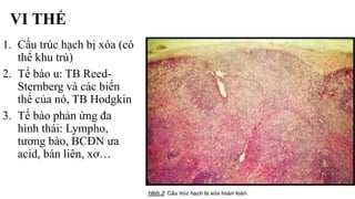 VI THỂ
1. Cấu trúc hạch bị xóa (có
thể khu trú)
2. Tế bào u: TB Reed-
Sternberg và các biến
thể của nó, TB Hodgkin
3. Tế bào phản ứng đa
hình thái: Lympho,
tương bào, BCĐN ưa
acid, bán liên, xơ…
 