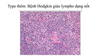 Type thêm: Bệnh Hodgkin giàu lympho dạng nốt
 