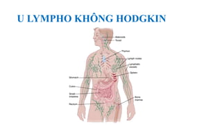 U LYMPHO KHÔNG HODGKIN
 