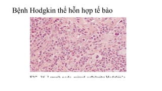Bệnh Hodgkin thể hỗn hợp tế bào
 