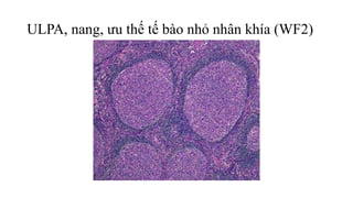 ULPA, nang, ưu thế tế bào nhỏ nhân khía (WF2)
 