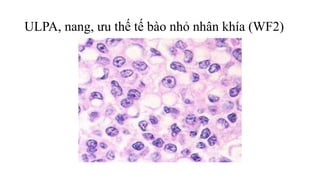 ULPA, nang, ưu thế tế bào nhỏ nhân khía (WF2)
 