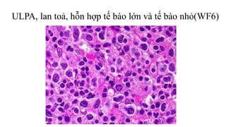 ULPA, lan toả, hỗn hợp tế bào lớn và tế bào nhỏ(WF6)
 