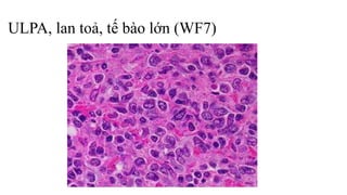 ULPA, lan toả, tế bào lớn (WF7)
 
