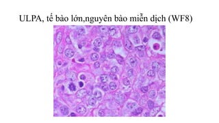ULPA, tế bào lớn,nguyên bào miễn dịch (WF8)
 