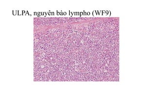 ULPA, nguyên bào lympho (WF9)
 