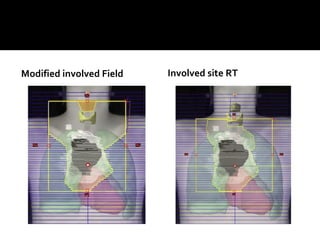 Modified involved Field Involved site RT
 