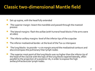37
Classic two-dimensional Mantle field
 Set up supine, with the head fully extended
 The superior margin- bisect the mandible and passed through the mastoid
process
 The lateral margins- flash the axillae (with humeral head blocks if the arms were
at sides)
 The inferior axillary margins- level of the inferior tips of the scapulae
 The inferior mediastinal border- at the level of theT10-11 interspace
 The lung blocks- to provide 1-cm margin around the mediastinal contours and∼
also encompass the pulmonary hilar lymph nodes
 The superior most point of the lung blocks was no higher than the inferior tip of
the head of the clavicle with the tops of the lung blocks tapered laterally, often
parallel to the projection of a posterior rib, in order to expose the high
axillary/infraclavicular lymph nodes.
 