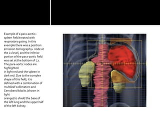 Example of a para-aortic–
spleen field treated with
respiratory gating. In this
example there was a positron
emission tomography+ node at
the L1 level, and the inferior
portion of the para-aortic field
was set at the bottom of L2.
The para-aortic nodes are
highlighted
in light red and the spleen in
dark red. Due to the complex
shape of this field, it is
defined with a combination of
multileaf collimators and
Cerrobend blocks (shown in
light
orange) to shield the base of
the left lung and the upper half
of the left kidney.
 