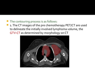  The contouring process is as follows:
 1.The CT images of the pre chemotherapy PET/CT are used
to delineate the initially involved lymphoma volume, the
GTV-CT as determined by morphology on CT
 